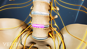 Anterior view of lumbar spine showing healing over artificial disc.