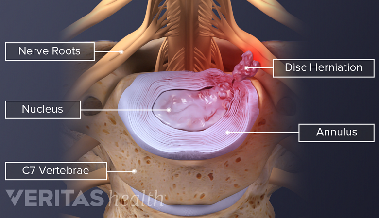Illustration showing cervical vertebra with herniated disc.