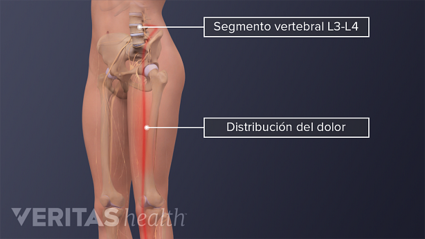 La distribución del dolor en el segmento vertebral L3-L4.