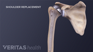 Medical illustration of reverse shoulder replacement procedure