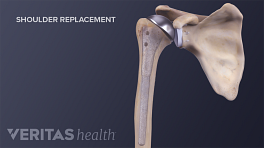 Medical illustration of reverse shoulder replacement procedure