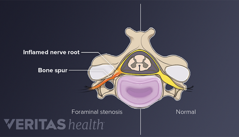 An illustration showing cervical vertebra showing normal vertebra on one half and foraminal stenosis on the other half.