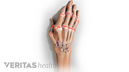 Medical illustration showing arthritis in a hand