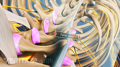 New bone formed as a result of calcification caused by ankylosing spondylitis is weak, and therefore more susceptible to stress fractures.