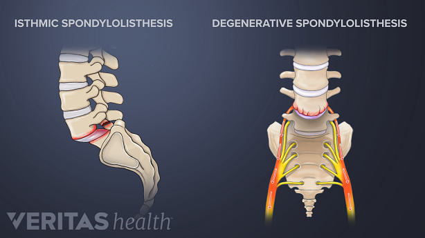 illustration of isthmic and degenerative spondylolisthesis.