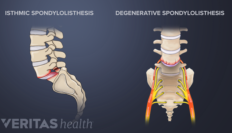 Illustartion showing spondylolisthesishesis in the lumbar vertebra.