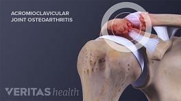 Medical illustration showing acromioclavicular (AC joint) osteoarthritis in the shoulder
