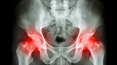 X-ray of the hips with hip joints highlighted in red