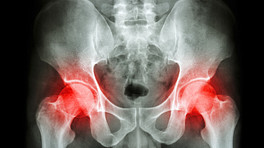 X-ray showing pain in the hip joints