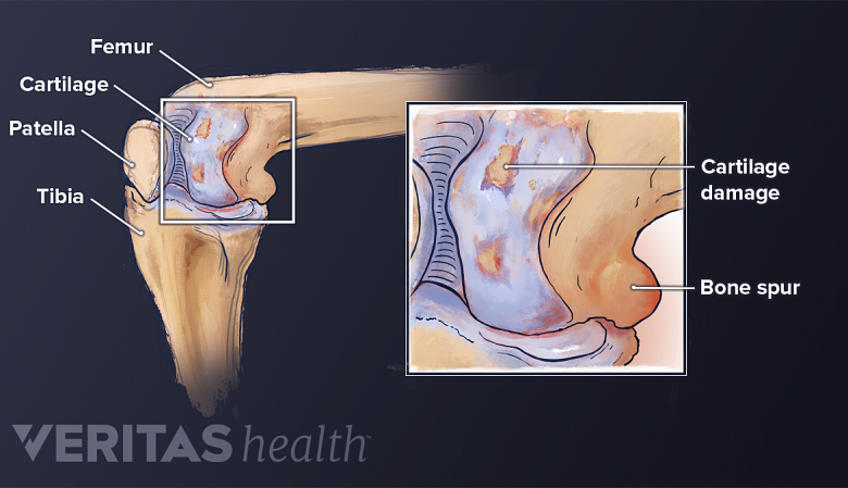 Illustration of the anatomy of knee osteoarthritis