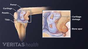 Anterior view of osteoarthritis in the knee labeling tibia, femur, patella, cartilage, bone spur, and cartilage damage.
