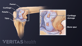Anterior view of osteoarthritis in the knee labeling tibia, femur, patella, cartilage, bone spur, and cartilage damage.