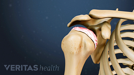 Illustration of shoulder bones showing humeral head cartilage degeneration