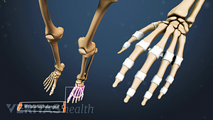 Illustrated skeleton showing arthritis in the metatarsophalngeal joints