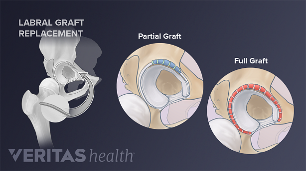 Partial and full labral graft replacement during hip labral reconstruction surgery