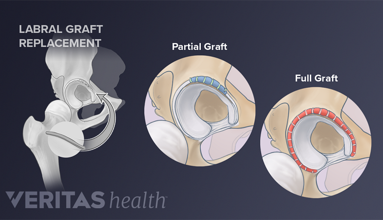 Partial and full labral graft replacement during hip labral reconstruction surgery