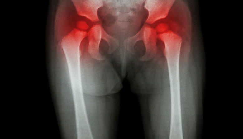 X-ray lower body with pain in the knees and hips.