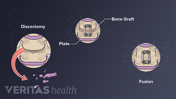Steps in spinal fusion: removal of the disc, insertion of bone graft, fixing of plates and screws, and fusion of the segment.