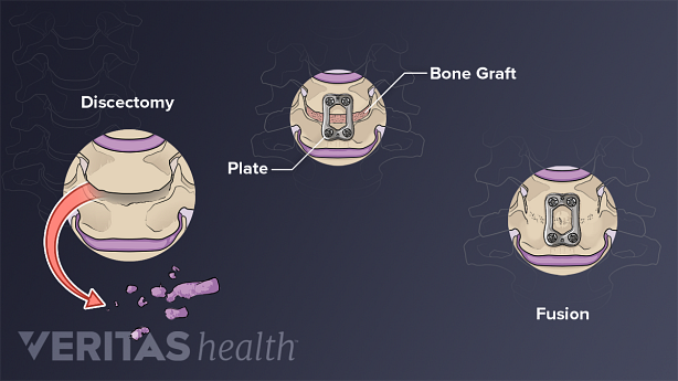 Medical illustration showing ACDF surgery steps.
