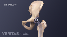 What to do before your hip surgery