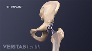 Medical illustration of a placed hip implant
