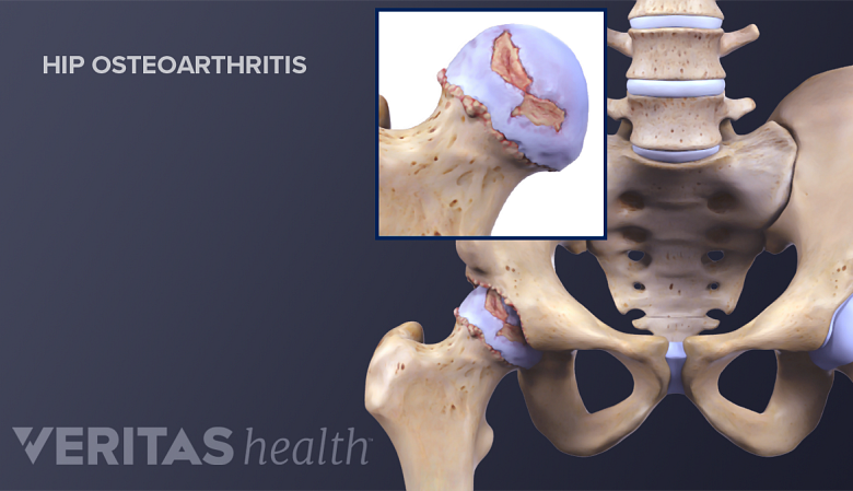 Medical illustration of a hip joint. Inset shows cartilage wear which is also called osteoarthritis.