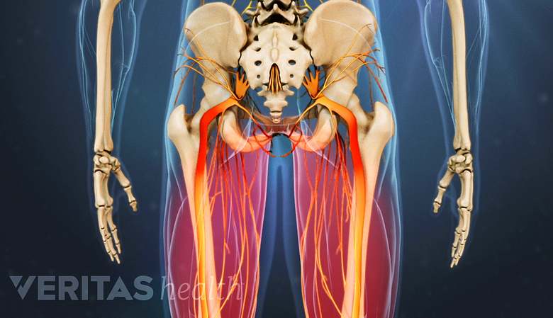 Posterior diagram of the nerves of the legs with pain highlight in red.