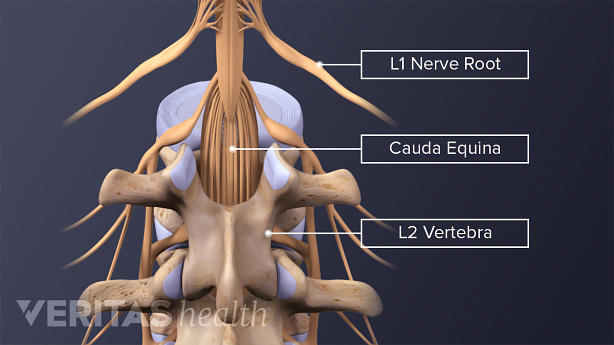 An illustration showing cauda equina nerves in the spine.