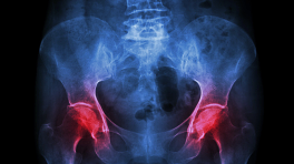 Both hip joints experiencing pain.
