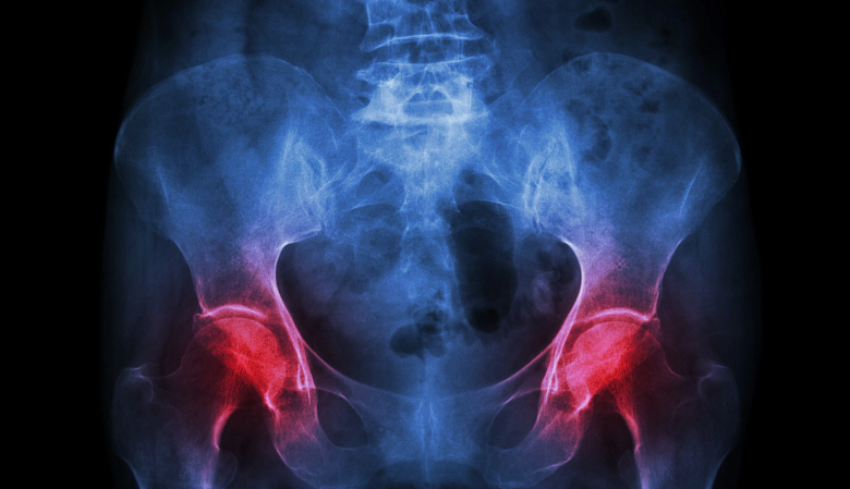 Both hip joints experiencing pain.