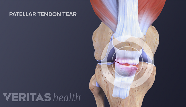 What You Need to Know About Kneecap Injuries