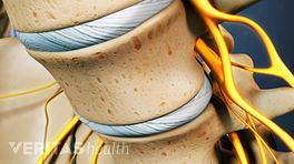 Close up view of lumbar vertebra showing degenerative discs.