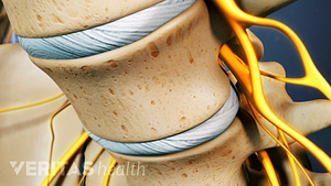 Close up view of lumbar vertebra showing degenerative discs.
