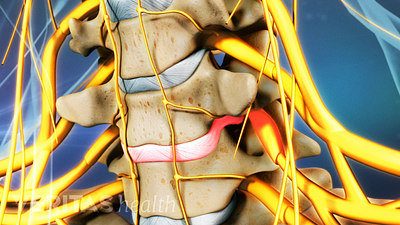 Vista anterior de hernia de disco en la columna cervical.