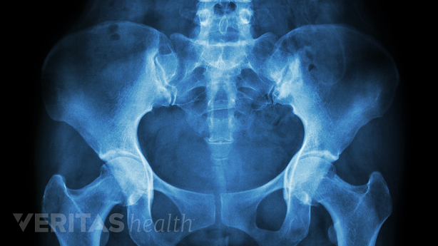 Illustration showing x-ray of pelvis and lumbar region.