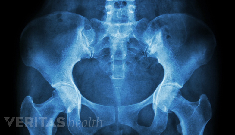 Illustration showing x-ray of pelvis.