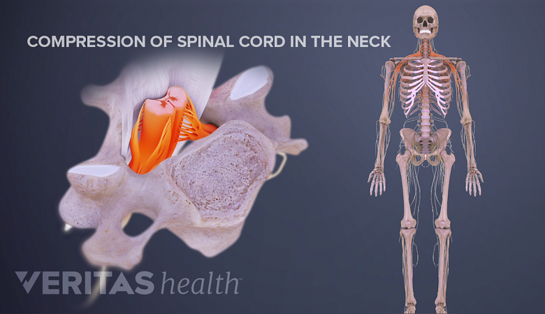 Illustration showing a skeleton with neck and shoulder highlighted in red and cervical vertebra showing spinal cord compression.