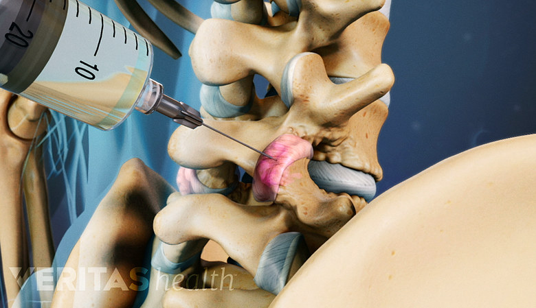 A needle injected into the facet joint.