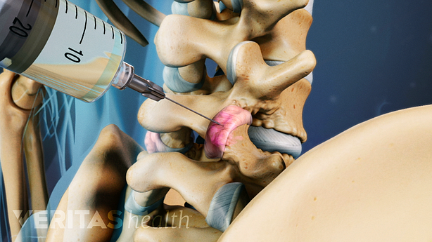 A needle injected into the facet joint.