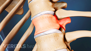 Close up medical illustration of a weakened vertebrae