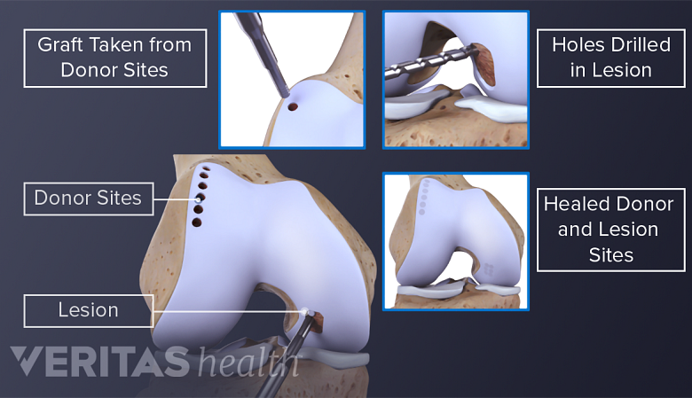 Illustration showing steps involved in Knee autograft surgery.