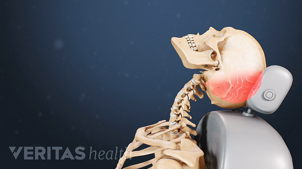 An illustration showing whiplash injury.