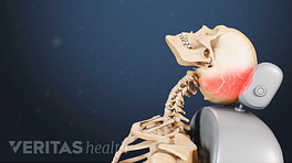 Profile view of whiplash impacting the neck and causing trauma to the back of the skull.
