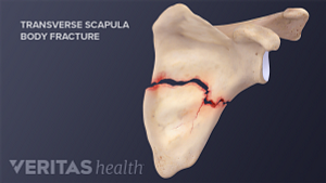 Scapula neck fracture with a plate repair