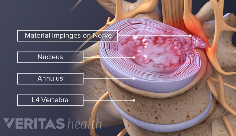 Illustration showing l4 vertebra impinging the nerve.