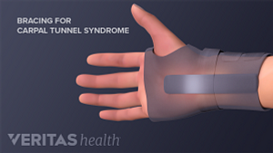 Non-surgical treatment for carpal tunnel syndrome includes bracing.
