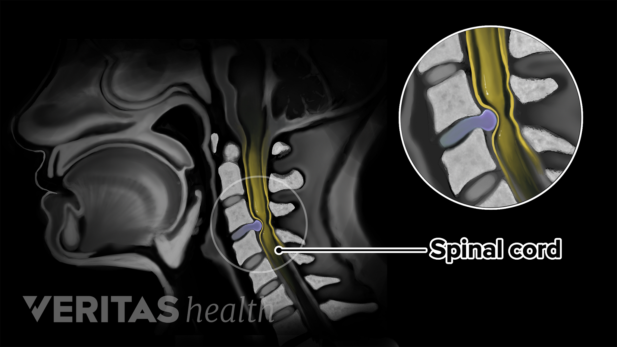 Diagnosis Of Spondylosis With Cervical Myelopathy | Spine-health