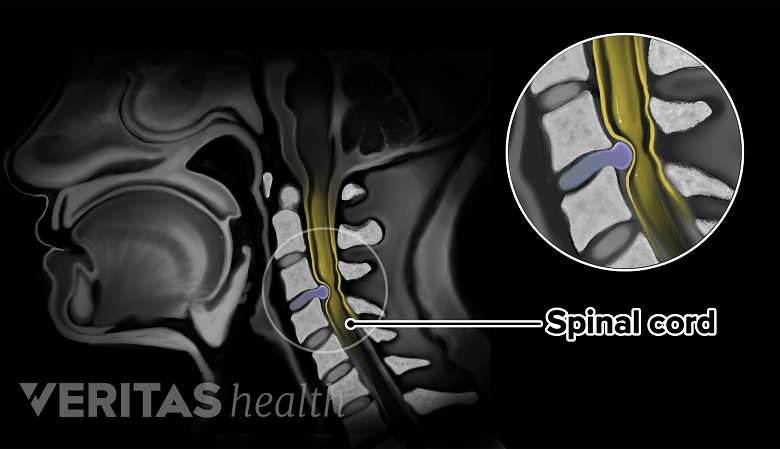 Illustration showing MRI scan of head and neck region showing herniated disc.