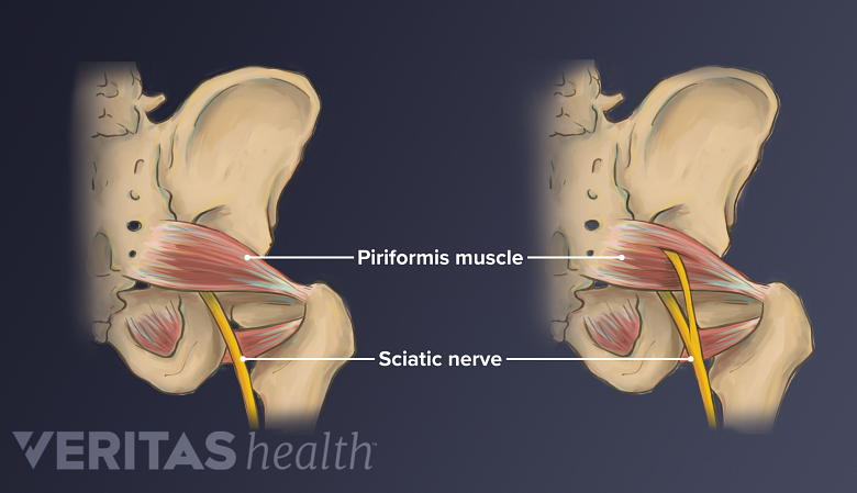 El lado izquierdo de dos pelvis que muestra la variación anatómica del nervio ciático a medida que discurre por debajo del músculo piriforme y a través del músculo piriforme.