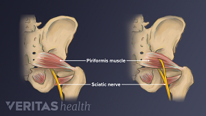 Vista posterior de la parte inferior del cuerpo que muestra el nervio ciático y el músculo piriforme.